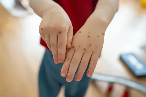 Understanding Malaria Treatment and Recovery