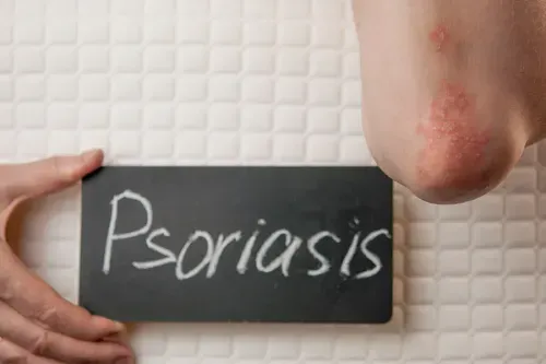 Understanding Psoriatic Arthritis and Its Treatment Options