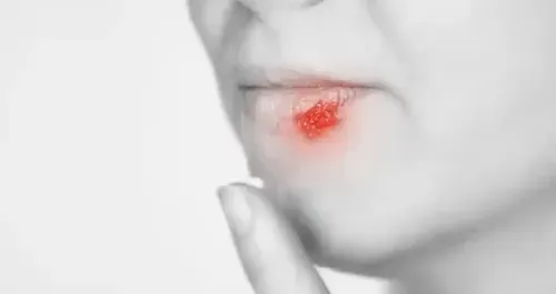 Effective Mouth Ulcer Treatment and Care