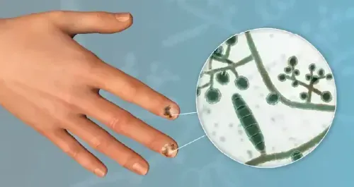 Nail Infections: Medical and Home-Based Treatment Options