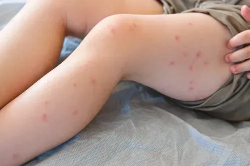 Understanding How Measles Affects Children