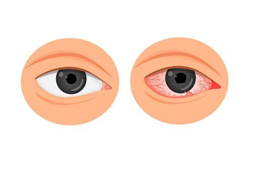 Symptoms of Uveitis: Causes, Types, and Treatment