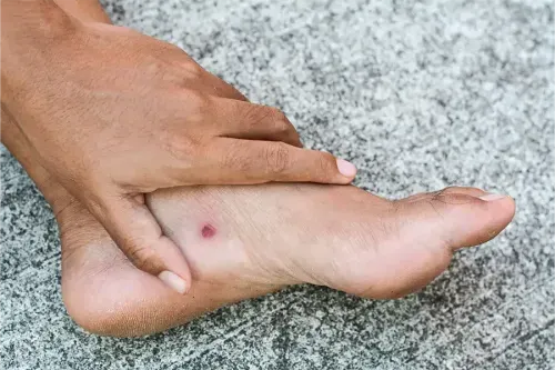 Health Insurance for Diabetic Foot Ulcers