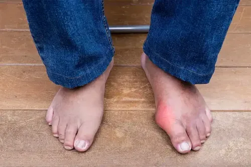 Gout Management Health Insurance Coverage