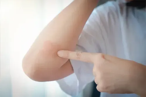 Health Insurance Coverage for Psoriatic Arthritis Care