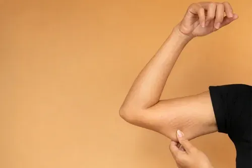 What is the Cost of Stretch Marks Treatment in Delhi?