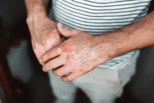 How Vitiligo Affects Skin Pigment