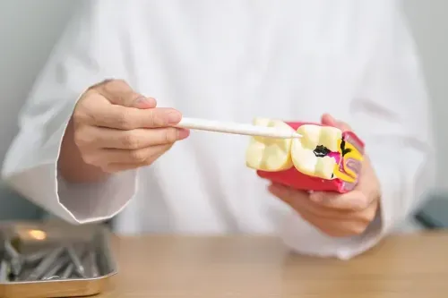 What are the Stages of Tooth Decay?
