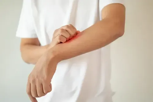 What is Eczema Disease?
