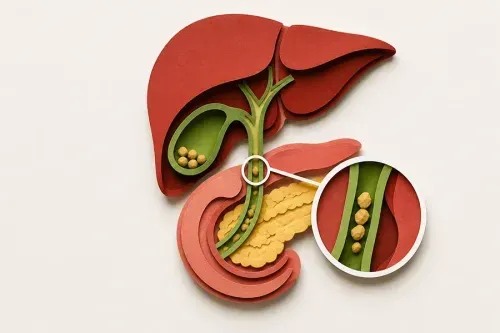 What is the Best Treatment for Choledocholithiasis?