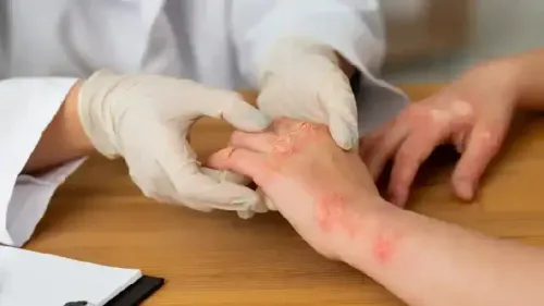 How is Psoriasis Detected?